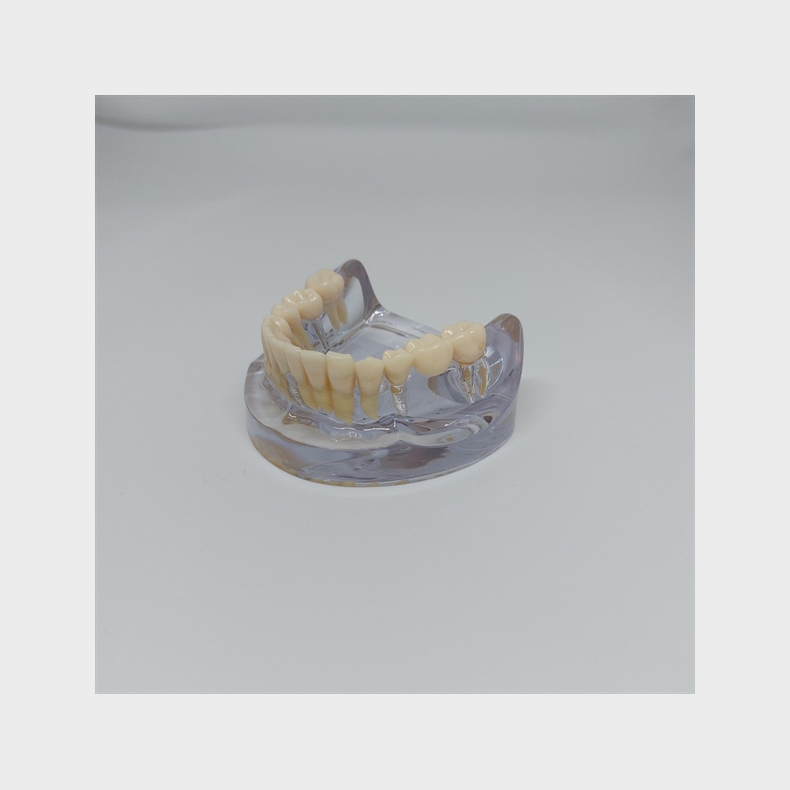 Implantat/Bro Studiemodel 